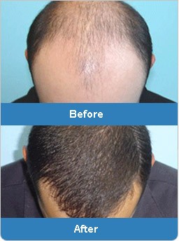 Best Hair Transplant cost offered: Solution of baldness problem