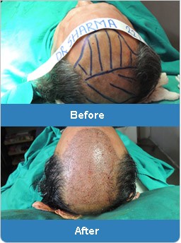 Best Hair Transplant cost offered: Solution of baldness problem