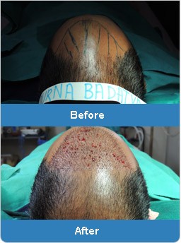 Best Hair Transplant cost offered: Solution of baldness problem