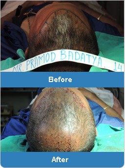 Best Hair Transplant cost offered: Solution of baldness problem